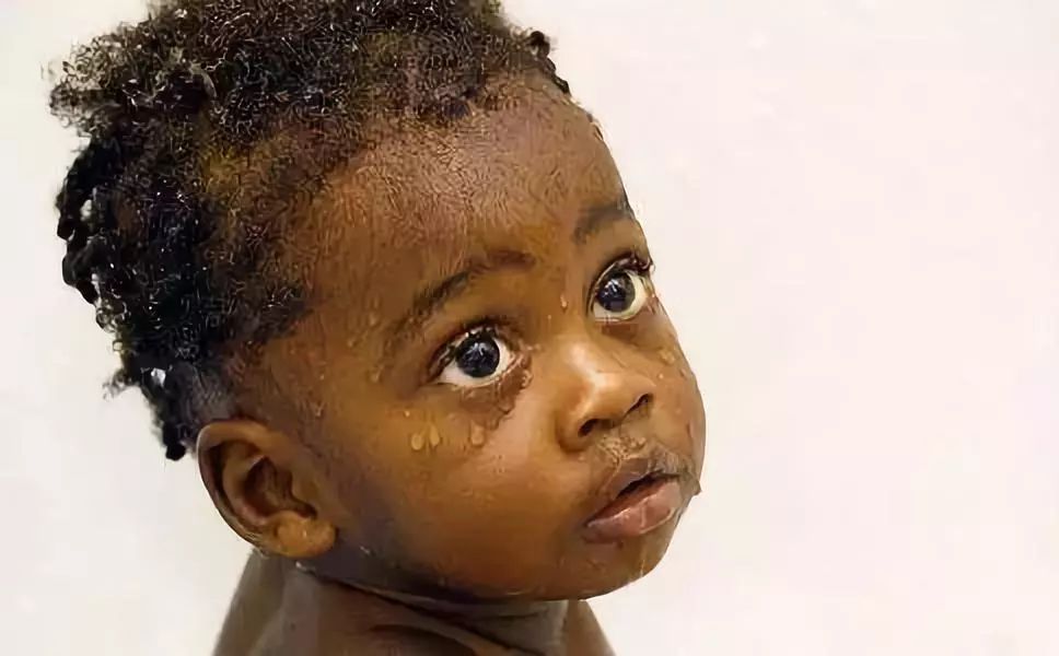 儿童会被传染艾滋病吗,小孩与艾滋病人一起生活会感染吗