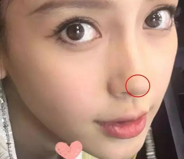 黑头多怎么办如何去除黑头,黑头贴去除顽固黑头