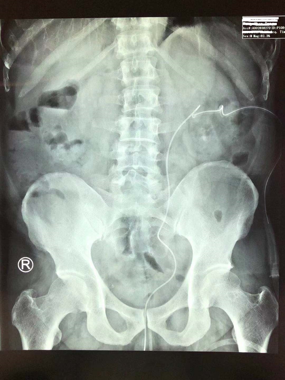 疯狂的石头碎石,疯狂的石头包世宏结石