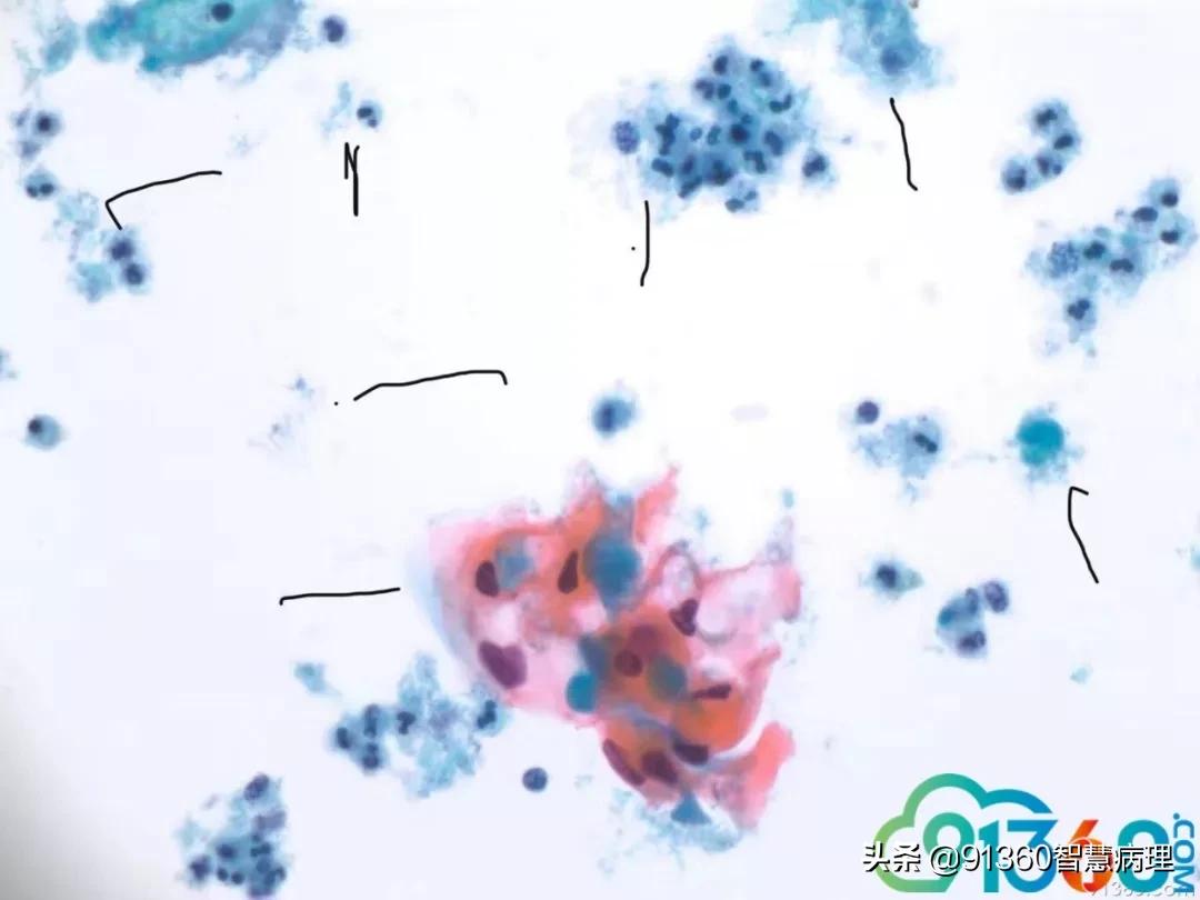宫颈病理检查与tct检查的区别,病理诊断宫颈活检鳞癌