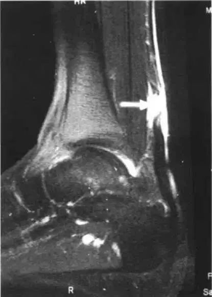 跟腱断裂和前叉损伤,前叉断裂和跟腱断裂哪个严重