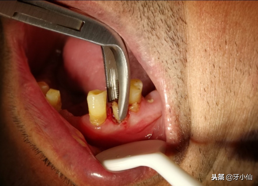 拔牙后真疼啊,拔牙后一般会疼多久