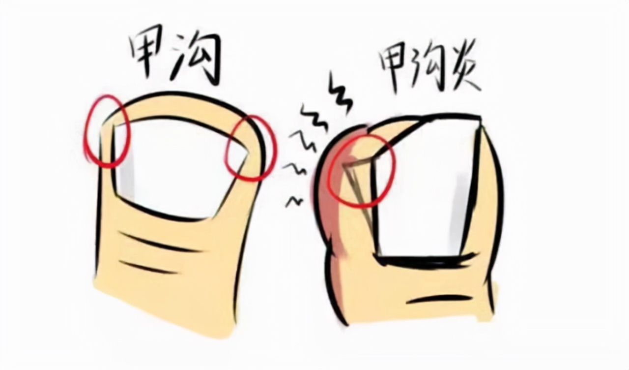 大脚趾甲很厚往肉里长怎么治疗,大脚趾甲受伤后变厚变脆怎么恢复