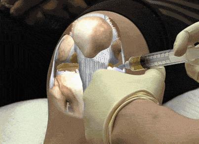 膝盖髌骨上下楼梯疼痛怎么办,髌骨外倾可以矫正过来吗