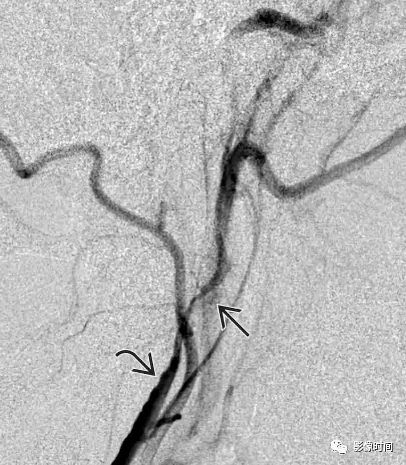 双侧颈动脉鞘间隙多发小淋巴结影,双侧颈动脉间隙多软组织密度结节