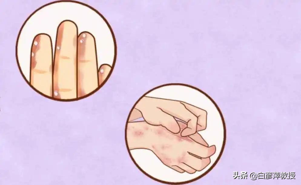 皮肤病乱用药当心雪上加霜,十种不能根治的皮肤病