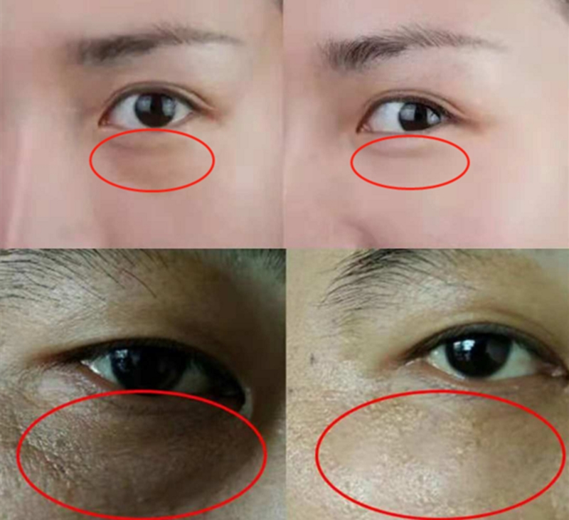 黑眼圈真的只是因为熬夜,熬夜党黑眼圈越来越严重怎么办