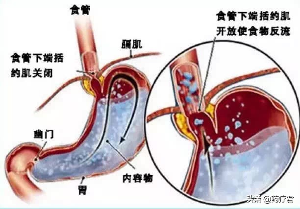 胃酸吃什么解决胃酸的问题,胃酸多应该怎么办