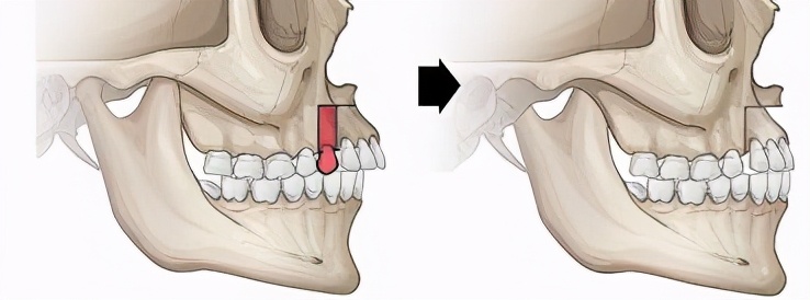 突嘴正颌手术有哪些风险,正颌手术凸嘴3d动画演示