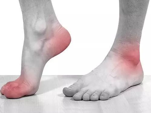 引起痛风疾病的主要原因是什么,中医解释痛风是什么原因引起的