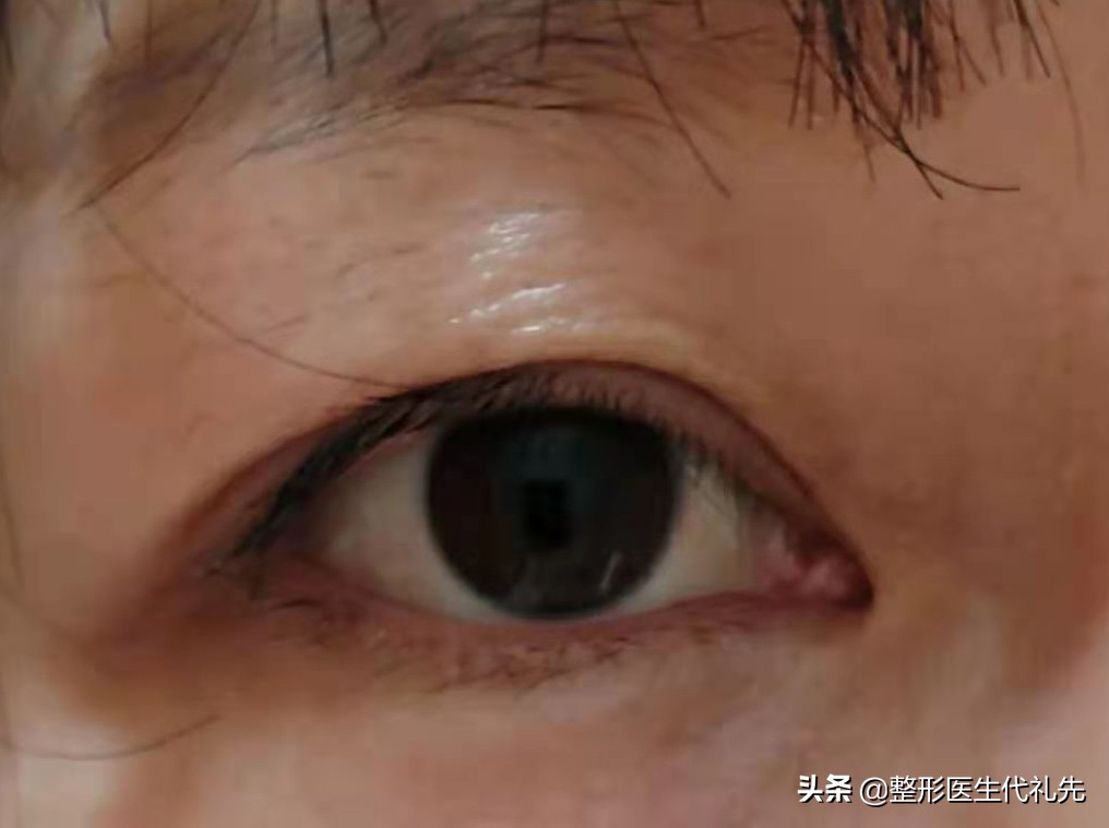 提眉手术疤痕凹凸不平,提眉手术后红肿怎么办