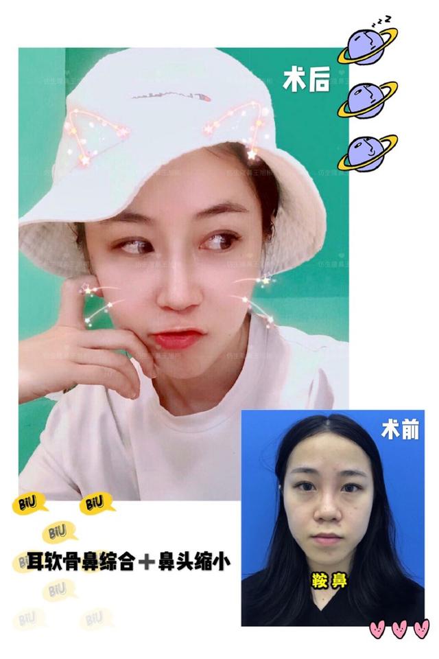 隆鼻手术十大常见问题的应对方案,隆鼻手术前应该准备带什么东西