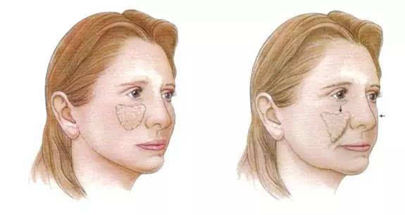 法令纹不是每个人都有的吗,有法令纹的人必须看吗