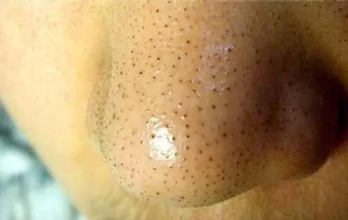 黑头镊子清理过程,专业黑头清理过程