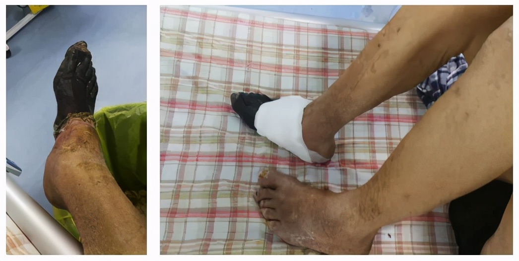 伤口长虫子了是怎么回事,为什么有些伤口一直不痊愈