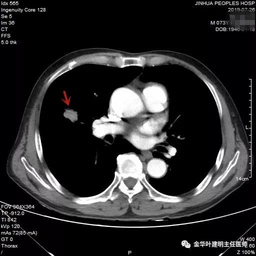 能不能手术,极重度混合性通气功能障碍能治吗
