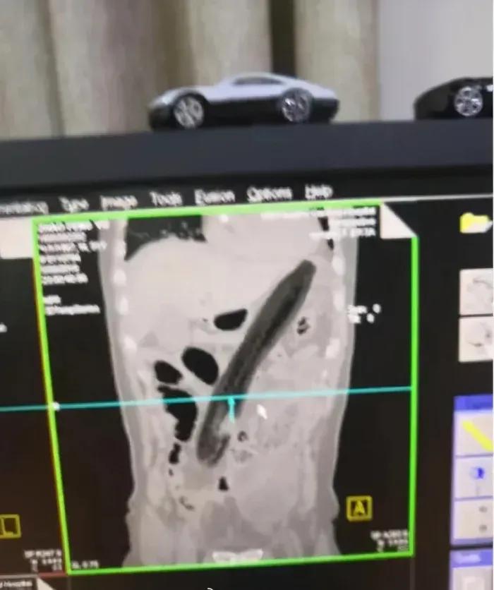 菊花塞足球，人体的极限到底有多大？