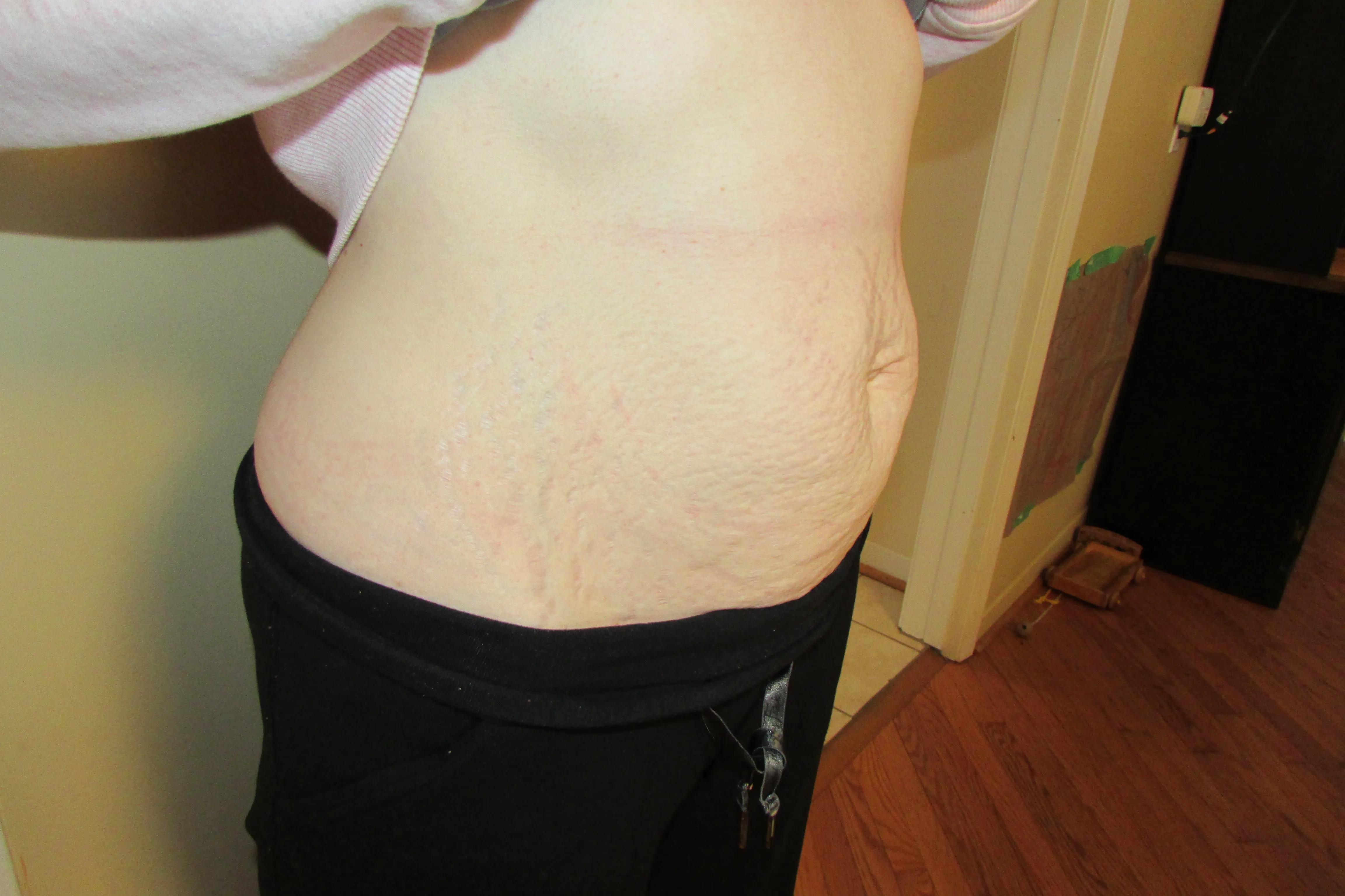 26岁双胎妈妈,双胎剖腹产肚子松弛