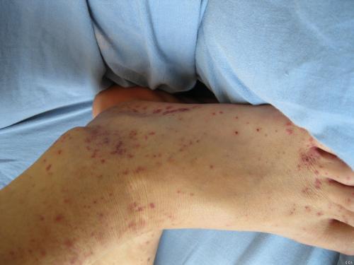 血液过敏性紫癜容易治疗么,妊娠合并血小板减少性紫癜表现