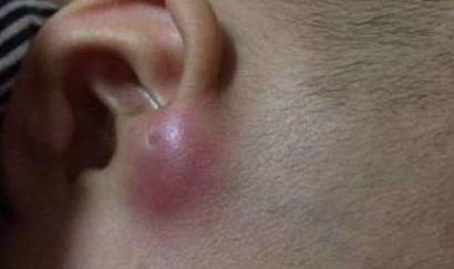 孩子耳朵里长了肉球,耳朵旁边有个小肉球几岁可以切除