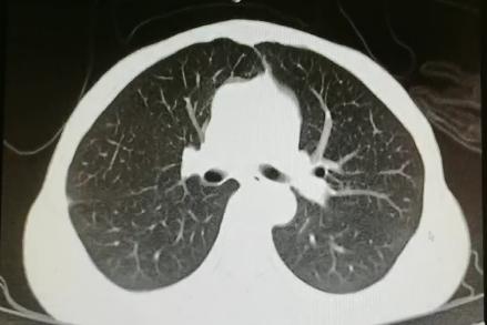 重度高碳酸血症突出表现,出现消化系统疾病的临床表现