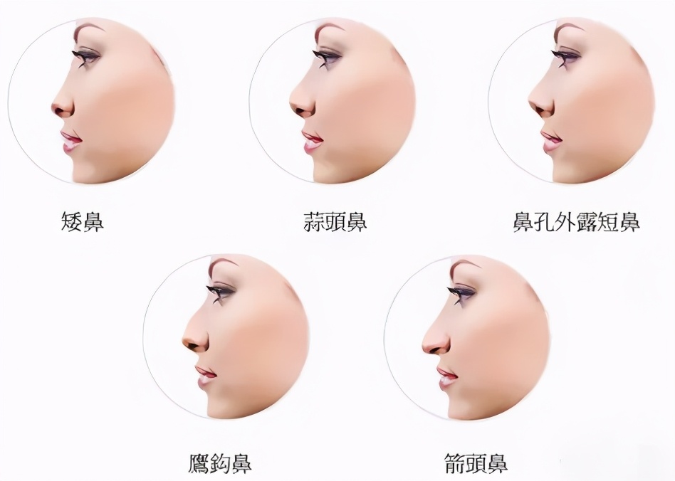 蒜头鼻怎么自己矫正,蒜头鼻塌鼻梁朝天鼻怎么改善