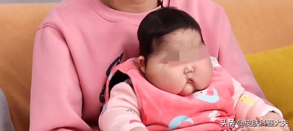 湿疹的最佳软膏无激素,湿疹抹激素软膏会有什么副作用