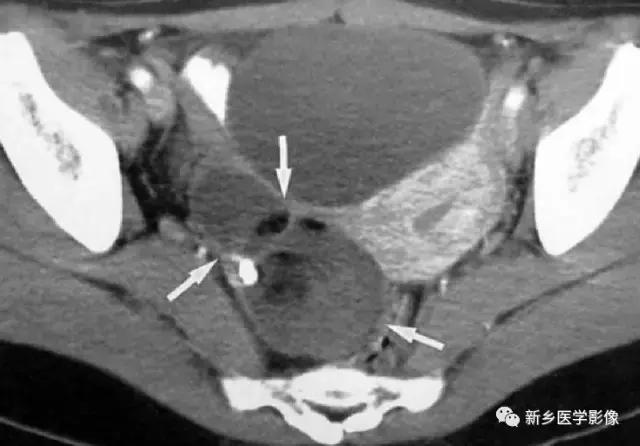 腹部平片可以看出肠胃疾病吗,腹部散在结节状高密度影