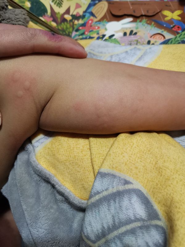 宝宝身上起好多疙瘩，跟蚊子咬的差不多，很痒，怎么办亲身经历