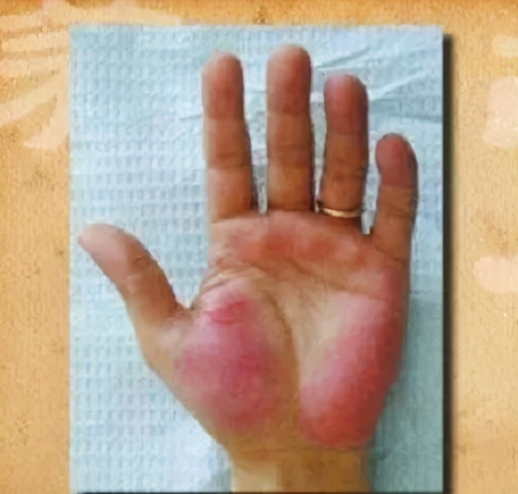 肝病身上出现小红点是怎么回事,肝病患者身上出现小红点意味什么