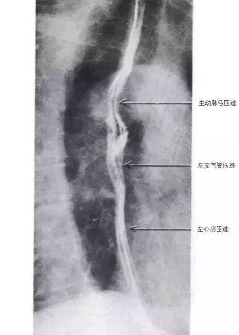 「收藏」11种消化道造影解剖图谱