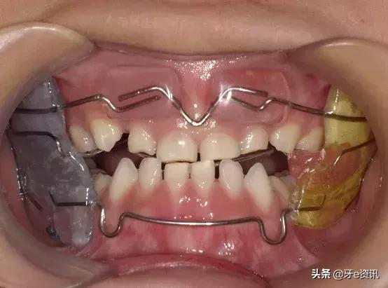 乳牙地包天会自动好吗,乳牙地包天矫正活动器