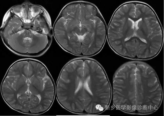 脱髓鞘样改变的mri表现,髓鞘形成稍延迟区