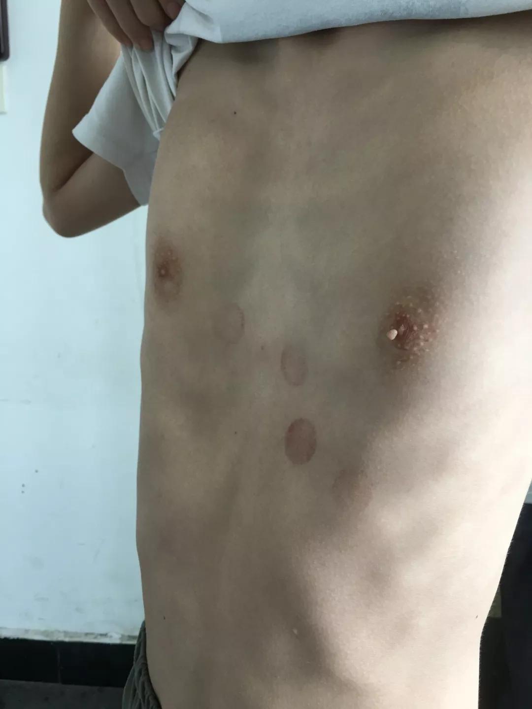 14岁男孩因“漏斗胸”自卑想退学，这是种什么病？