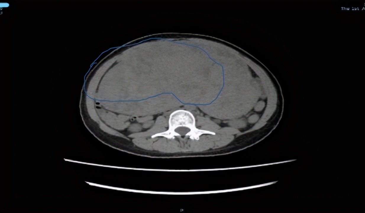 100斤女子肚子变大以为发胖原来是8斤肿瘤挤满腹腔