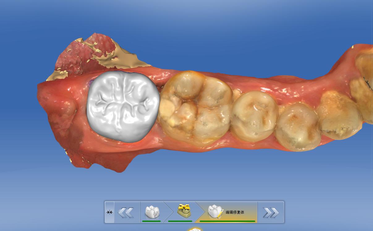 补牙补次数多了洞会越来越大吗,补牙补几次能补完