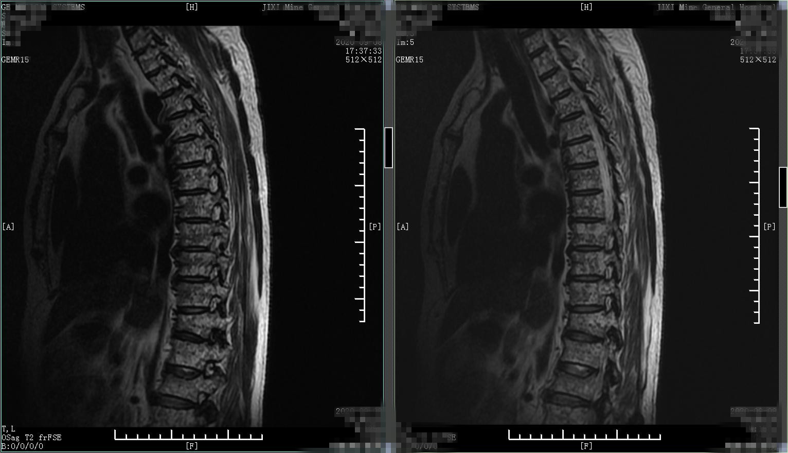 老年人腰腿痛不要忽视,中老年人腰背部酸痛