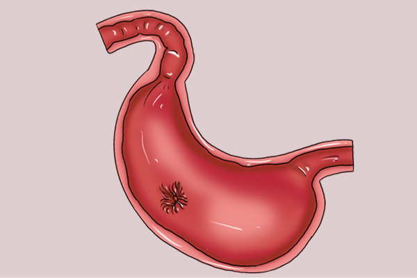 有胃病的人能不能吃维生素c,胃病能吃维生素c吗