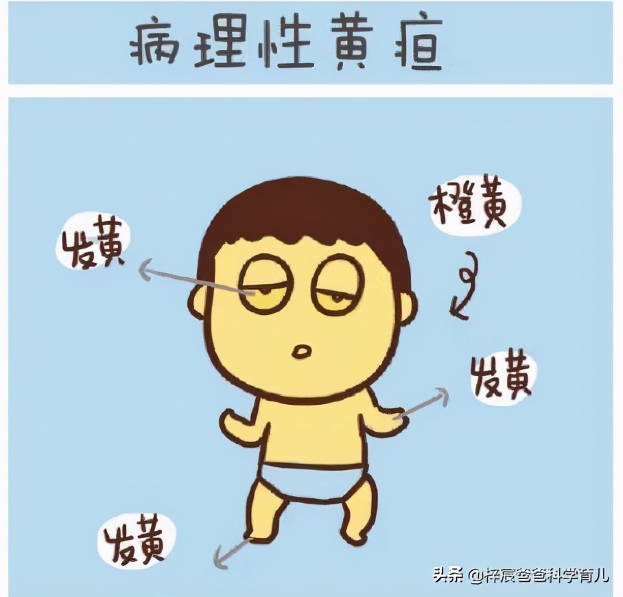 新生儿常见的黄疸症状是什么呢,新生儿黄疸严重程度如何划分