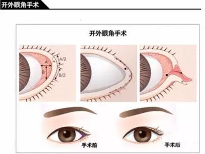 开内眼角会遗留明显疤痕吗,十个开眼角十个留疤