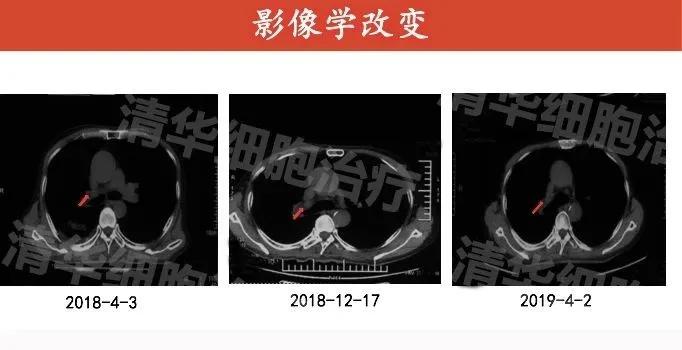 肺癌晚期活不了多久的症状,肺癌晚期生命只剩下六个月