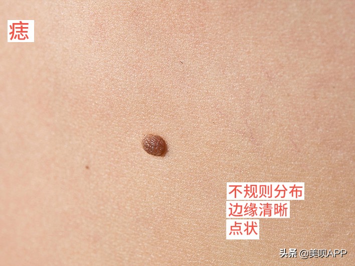 脸上有斑怎么祛斑最快最有效,脸上长斑点用什么药才能祛斑