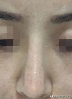 短塌鼻子可以做成直鼻吗,塌鼻子怎么能变成尖鼻子