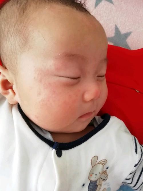 渗出性湿疹的症状和表现,小儿湿疹症状表现有哪些