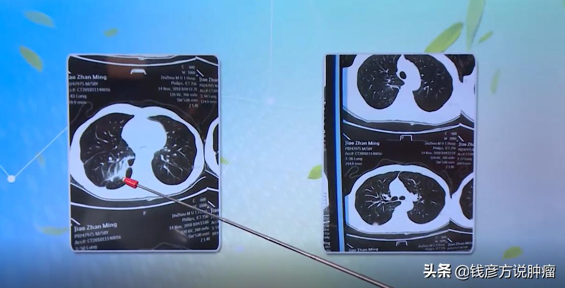 肺癌和肾癌靶向药物,肾癌术后转移肺癌早期还好治吗