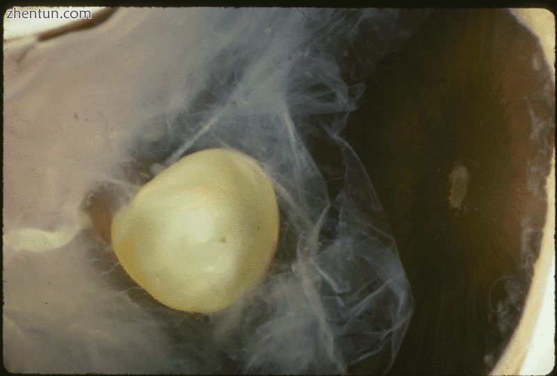 马凡综合征特殊面容,马凡综合征完整