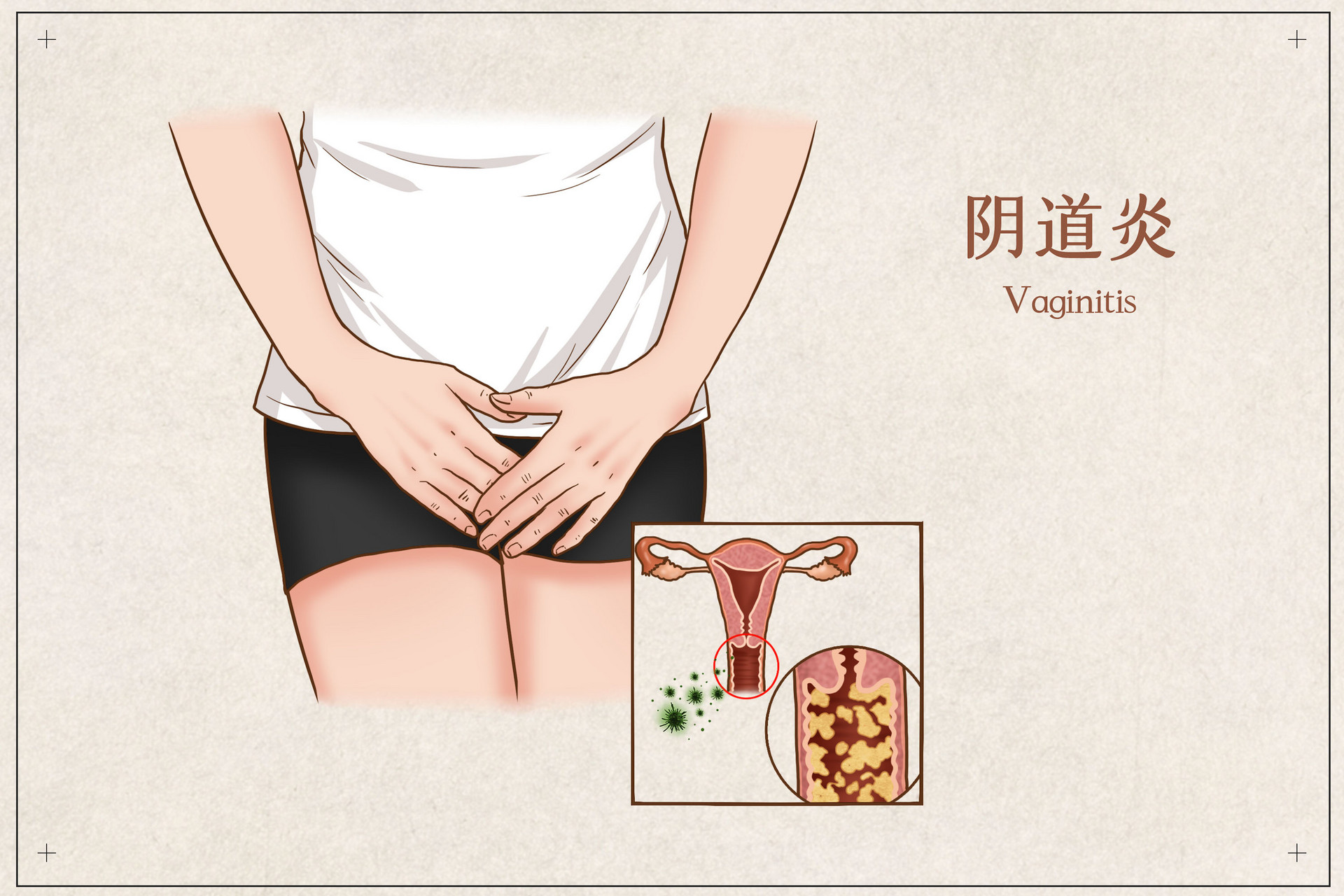 如何辨别妇科炎症？你先得了解女性的“秘密花园”，注意预防