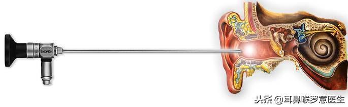 耳科医生掏耳屎的过程,医生掏耳屎负压吸引术