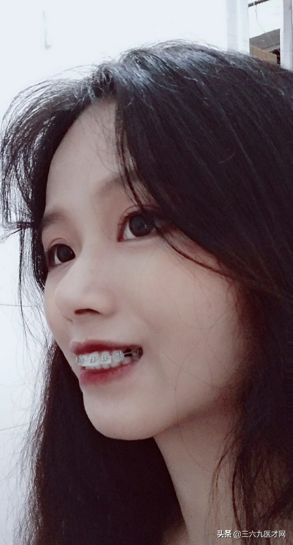 2周岁龅牙可以矫正吗,微龅牙整完后悔吗