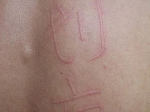 人工性荨麻疹是什么原因导致,人工性荨麻疹是什么原因导致的